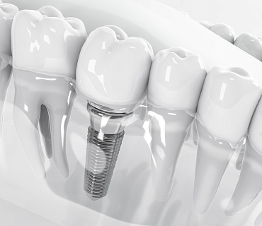 Какие имплантаты зубов лучше поставить?