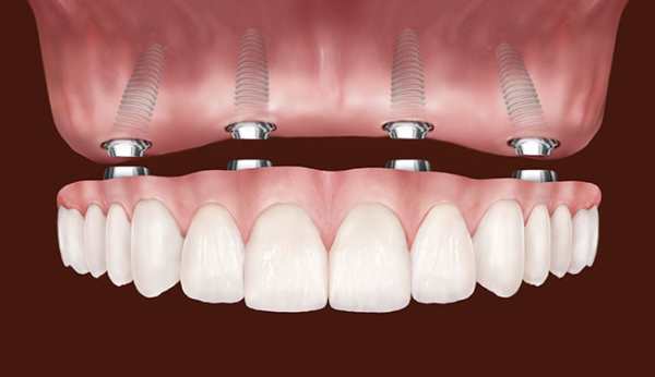Комплексная имплантация зубов методом all-on-4