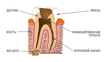 гнойное воспаление мягких тканей, которые расположены у корня зуба