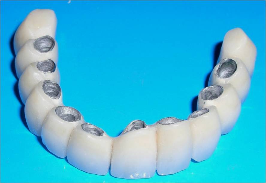 Комплексная имплантация зубов
