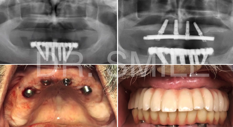Имплантация и протезирование зубов All-on-4