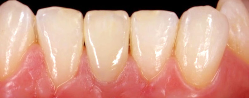 Восстановление зуба трансгивальным методом