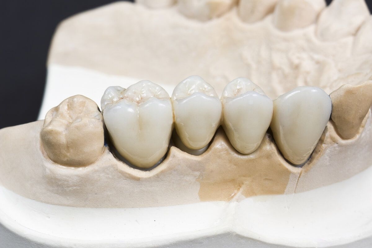 Особенности имплантации передних зубов верхней челюсти