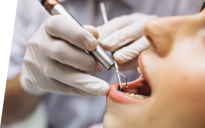 Лечение кариеса зубов