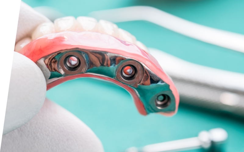 Все на 4 имплантах (All-on-4) Все на 4 имплантах (All-on-4)