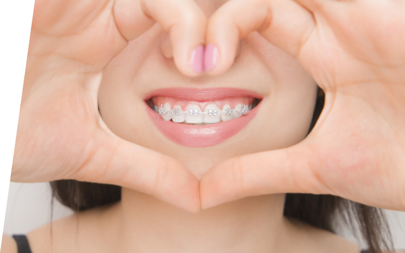 Сапфировые брекеты