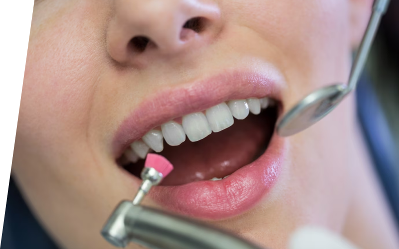 Снятие зубных отложений Снятие зубных отложений