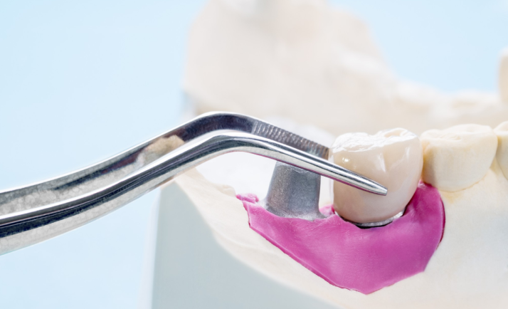 Коронки E-max Коронки E-max