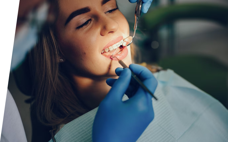 Прозрачные брекеты