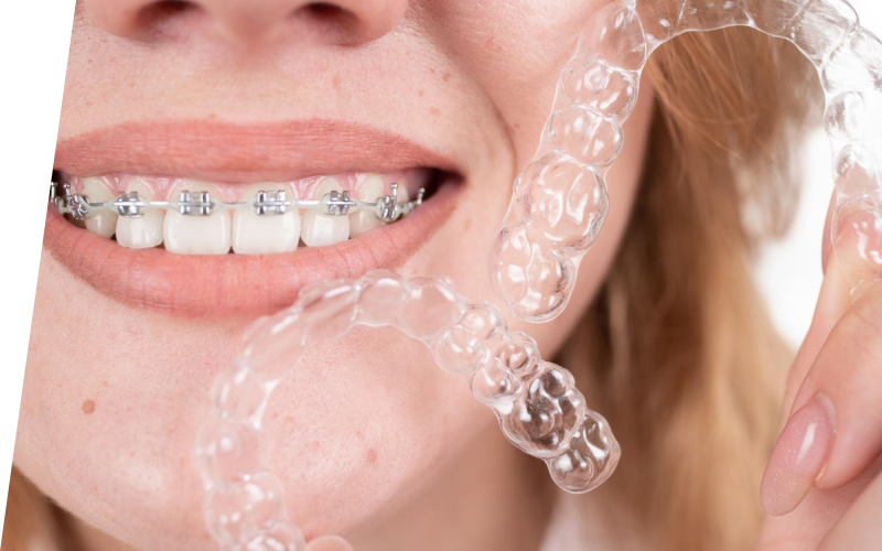 Особенности ухода за сапфировыми брекетами