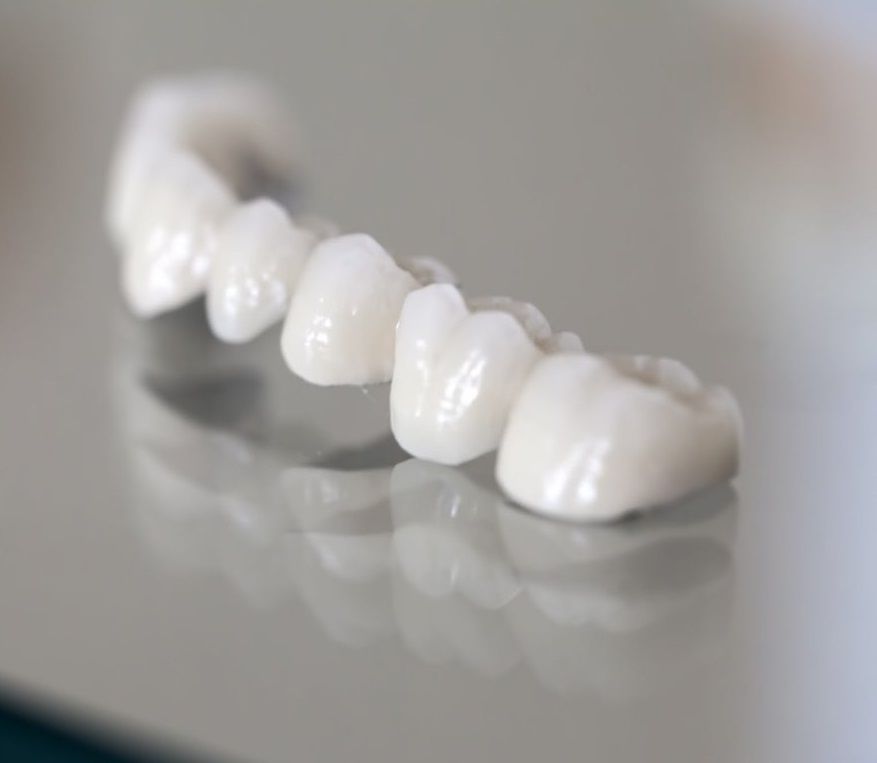 Преимущества коронок Е-мах