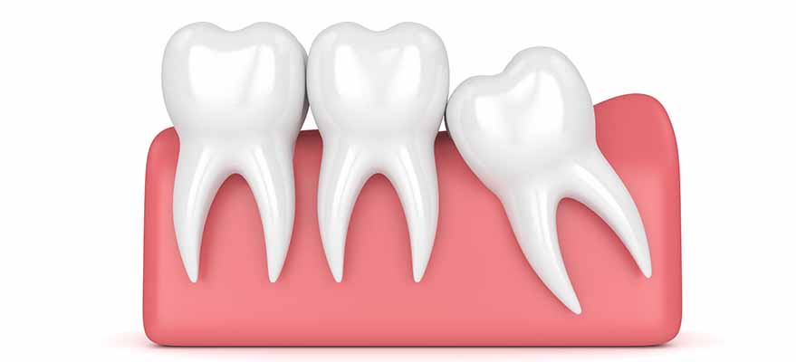 Болит зуб под пломбой: причины, что делать?