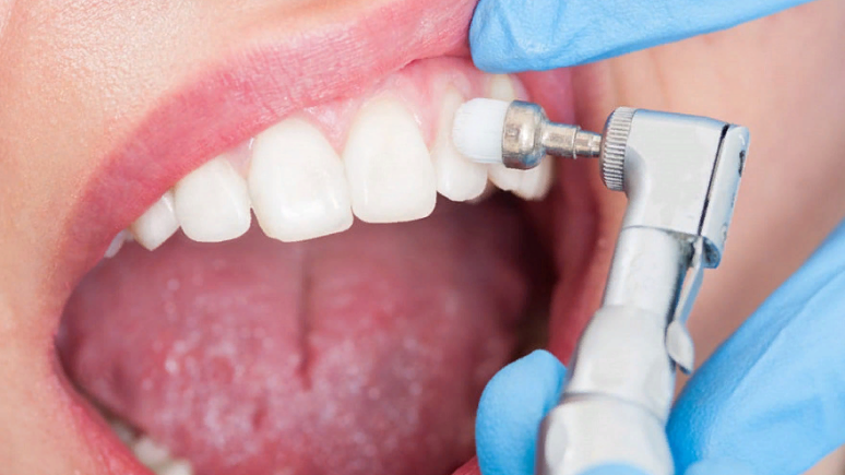 Профессиональная гигиена в Москве