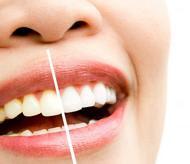 Безопасно ли отбеливание зубов?