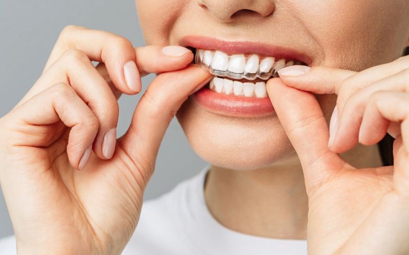 Элайнеры для выравнивания зубов