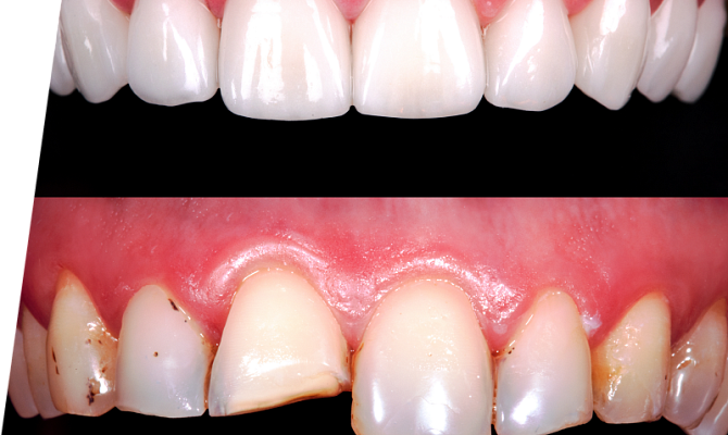 Откололся передний зуб