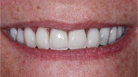 После лечения