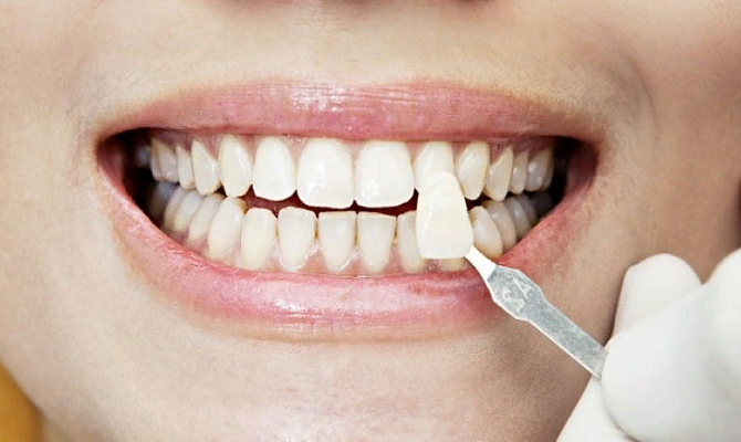 Откололась стенка зуба