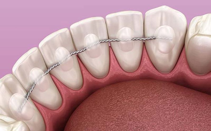 Вантовое шинирование зубов