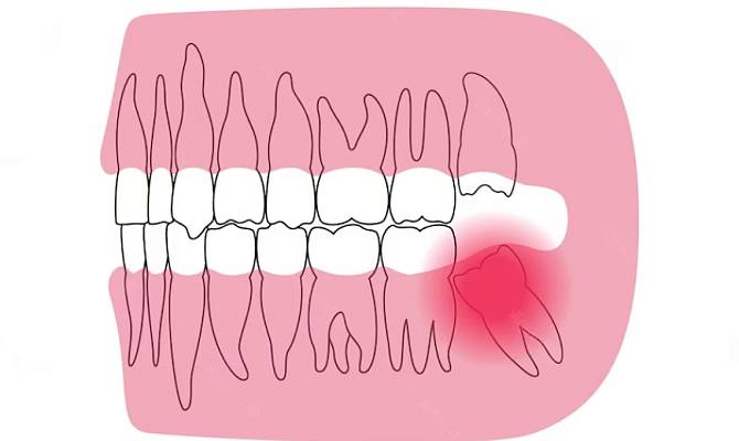 Перикоронит Перикоронит