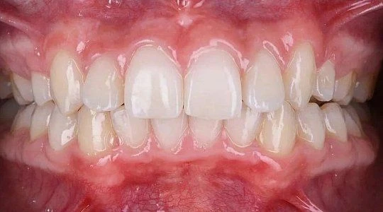 После лечения