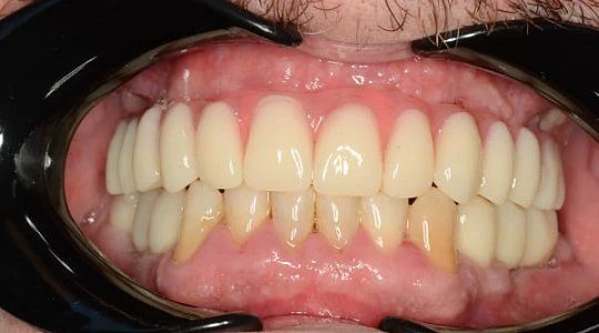 После лечения