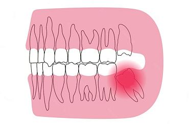 Перикоронит