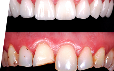 Откололся передний зуб