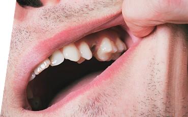 Альвеолит (сухая лунка) зуба