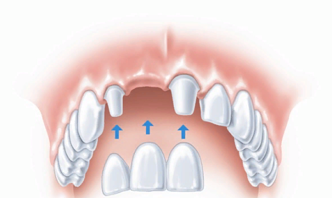 Правила пользования несъемными зубными протезами