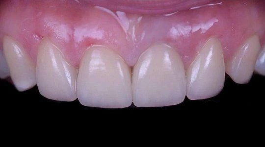 После лечения