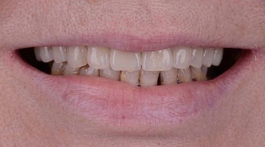 После лечения