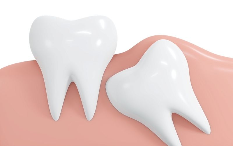 Удаление ретинированного зуба без боли и стресса