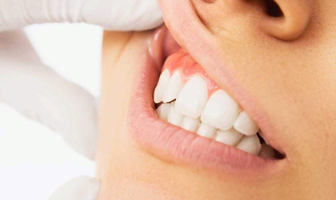 Шишка на десне