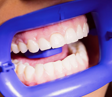 Сохранение и реставрация зубной эмали