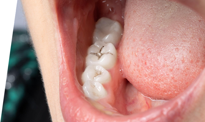 Металлический привкус во рту