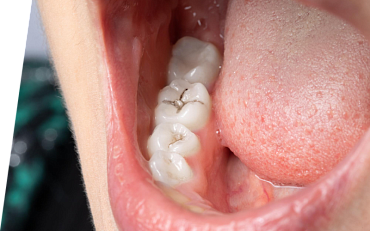 Металлический привкус во рту