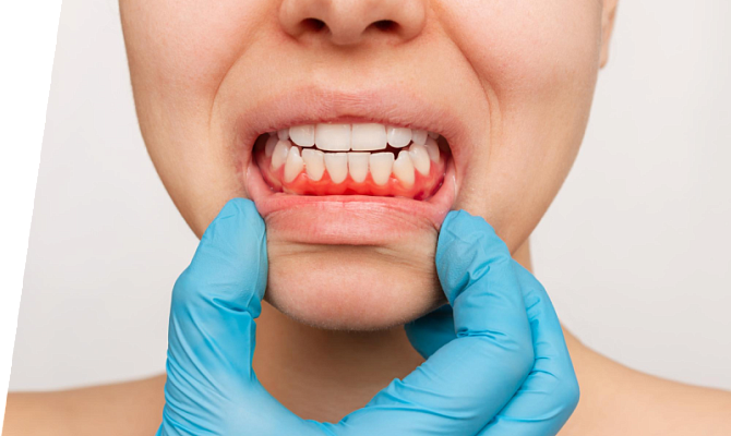 Болит десна Болит десна