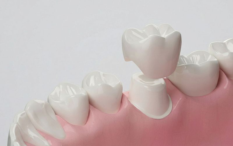 Коронка на зуб всего за 2 визита!