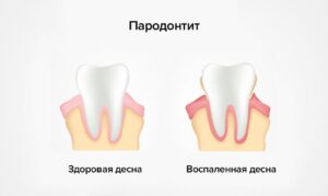 Что такое пародонтит?